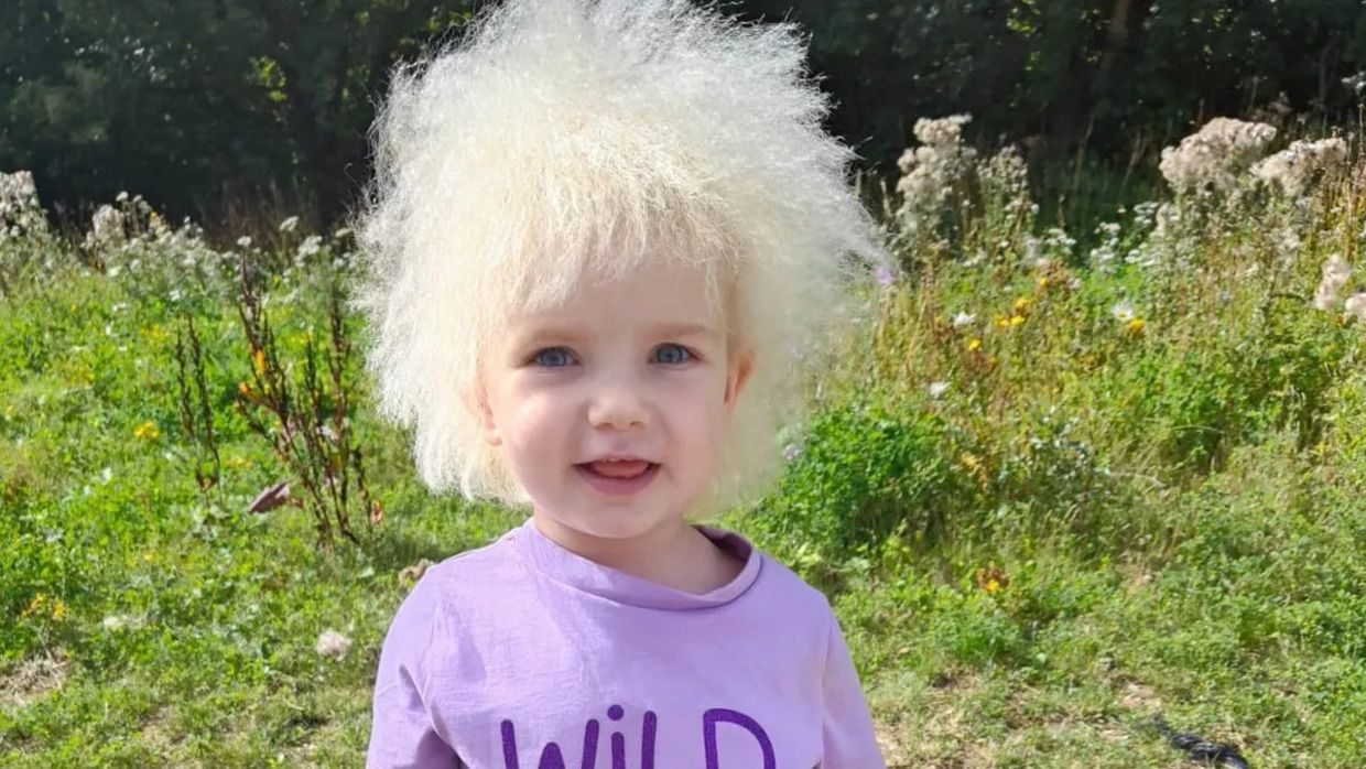 Лайла Девіс має рідкісне захворювання волосся Лайла Девіс має рідкісне захворювання волосся